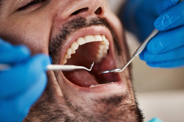 Best Emergency Tooth Extraction in Dover, FL